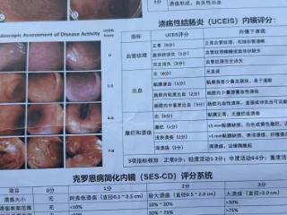 济南南郊医院消化内科：系统规范诊疗溃疡性结肠炎，身心兼顾护健康