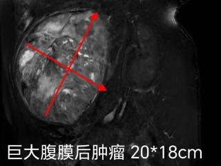 第医线③｜巧拆“巨弹”！淄博市中心医院多学科精切20公分巨瘤