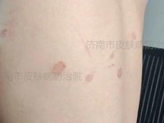 一只流浪猫惹的祸！王同学的“猫癣”历险记