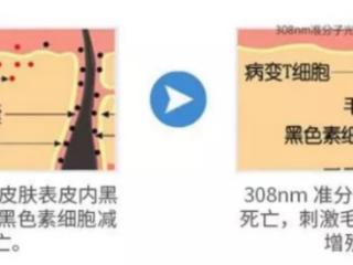 为何选进口308nm准分子激光？有效控制白癜风患者白斑扩散
