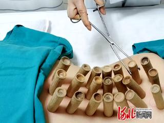 邢台市中心医院中医护理门诊应用药物竹罐技术治慢病