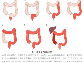济南南郊医院消化内科：精准个性化方案 守护溃疡性结肠炎患者健康