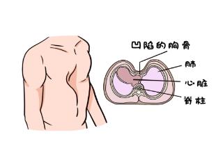 漏斗胸导致胸闷憋气——山东大学齐鲁医院德州医院小儿外科微创重塑10岁男孩的“挺拔人生”