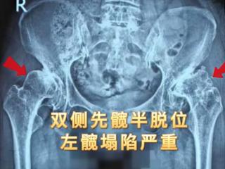 先髋脱位四十余年，从辽宁到山东她终于找回了健康行走的能力