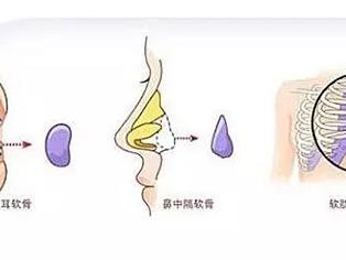 妈生鼻or网红鼻？如何选择适合自己的鼻型？厦门美莱隆鼻享大额福利补贴