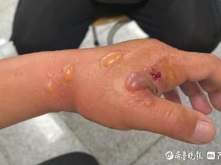 被鱼刺扎了一下险丧命！青岛市市立医院精准治疗为患者保全五指