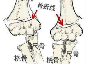 小儿骨折要等消肿后才治疗吗?