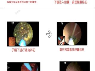 守护胆囊，微创取石——临沂市人民医院为患者的健康保驾护航