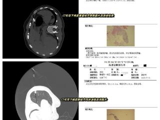 开拓创新，再破“禁区”——单县中心医院完成高难度CT引导下经皮胃壁穿刺联合肺结节同步活检消融术