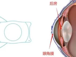 尖峰眼科提示：近视手术能摆脱哪些困境？