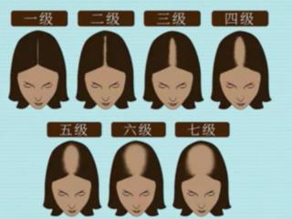 步长荣发：长期脱发困扰人群的新希望