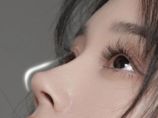 隆鼻为什么现在都建议做综合？厦门美莱鼻整形享大额福利补贴