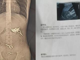 14灭火器保险销被顽童吞下肚！惊险救援敲响儿童安全警钟