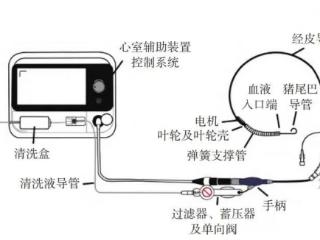 烟威首例！烟台毓璜顶医院心内一科团队用国产“心泵”为77岁高危患者打通“生命通道”