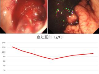 济南市五院消化科经介入栓塞成功救治消化道溃疡出血伴休克患者