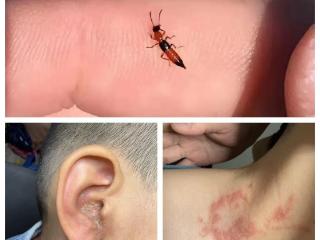 孩子遇隐翅虫，千万别拍打！皮肤科专家详解防护要点