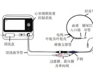 毓医关键字|毓璜顶医院以国产“心泵”为高危患者打通生命通道