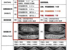 视力1.0，却总感觉看东西模糊，竟是干眼引发的！
