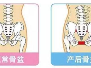 产后必修课：骨盆修复与盆底康复