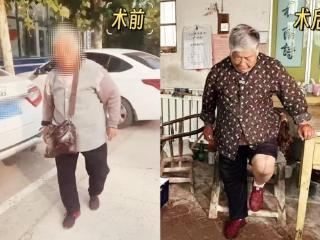 单侧膝关节骨性关节病困扰老人多年 济南南郊医院骨二科精准手术解病痛