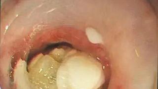 中秋雨夜，一枚枣核的“生命时速”——用专业点亮生命的月光