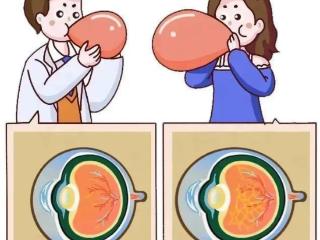 日照爱尔眼科小课堂丨近视度数高只是镜片厚吗？
