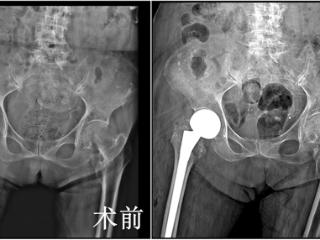 西安市红会医院MDT救助101岁股骨粗隆间骨折老人