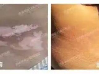 为什么治疗效果不好？许多患者还在犯！进来看白癜风专家怎么说