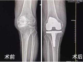 从步履维艰到大步行走，济南关节外科医院帮七旬老人告别膝关节炎
