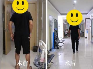 双侧股骨头坏死，术后20天脱拐如愿回归正常生活