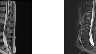 滨州中医医院开展肿瘤患者腰椎病理性骨折伴脊髓损伤微创术式治疗