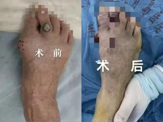 微创矫形+精准麻醉，拇外翻患者术后即可下地行走！