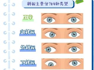 济南市眼科医院科普|斜视的危害和治疗方法