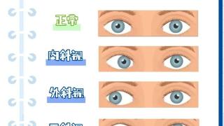 济南市眼科医院科普|斜视的危害和治疗方法(图1)