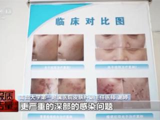 “针清”后痘痘不减反增 这些祛痘方法操作不当可能会“烂脸”