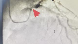 96岁“心”挑战！青岛西海岸第二医院心脏诊疗中心成功为超高龄患者实施高危介入手术