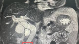 黄疸背后暗藏“隐形杀手”，北京大学人民医院青岛医院多学科协作突破外科手术天花板！