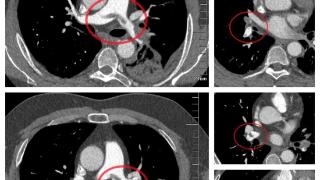 小伙因“感冒”就医，医生敏锐识破致命肺栓塞！精准介入取栓碎栓，成功化解“夺命危机”