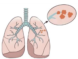 秋冬养肺正当时！济南南郊医院王言森教授提醒：肺结节人群需关注这些信号
