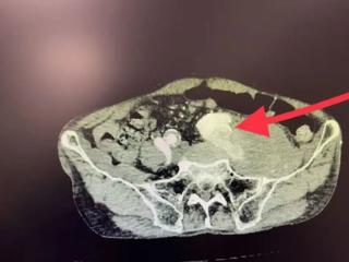 八旬老人突发腿肿，竟是“动脉炸弹”破裂！北大人民青岛医院血管外科顺利拆弹保平安