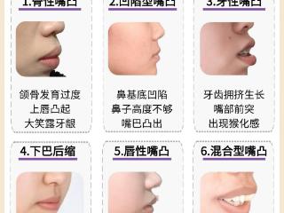杏林整形医院：6种嘴凸表现，你是哪一种？怎样摆脱土气感？