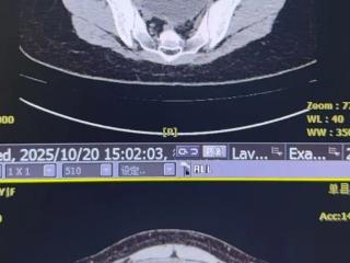 单县中心医院妇科成功完成一例盆腔巨大肿瘤合并骶前肿瘤的高难度手术