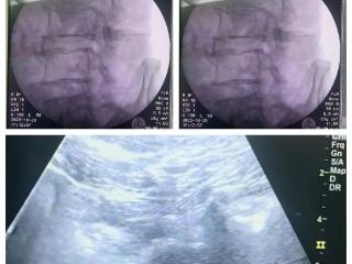 单县中心医院疼痛科开展超声+X线双引导腰交感神经阻滞术，为糖尿病足患者带来“温暖”希望
