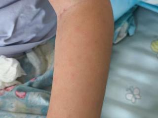 小叶医探 | 七岁女童持续高热不退，原来是“它”在作怪！