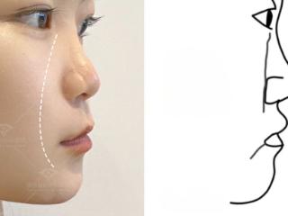 杏林整形：“拉面中”就是隆鼻或者填鼻基底吗？