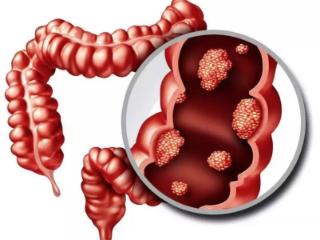 便血、腹痛别大意！君心肿瘤医院带你认清结直肠癌4大早期症状