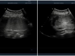 新选择，超声也能查胃肠！青岛妇女儿童医院上新喝杯“糊糊”就能做的胃肠超声造影检查