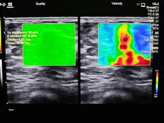 乳腺健康的“侦察兵”：详解超声筛查乳腺癌