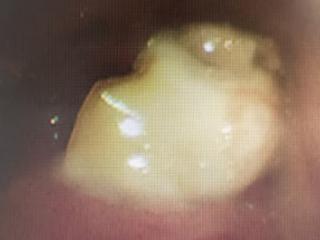 监控拍下1岁宝宝沙发跌落呛咳瞬间！儿内科医生呼吁：3岁以内孩子务必远离它！