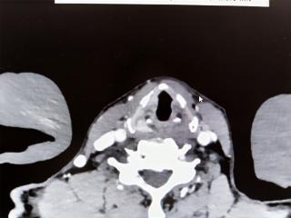 无嘶哑确诊喉癌，专家下沉+无缝隙转诊+高效救治，65岁老人在这里治愈